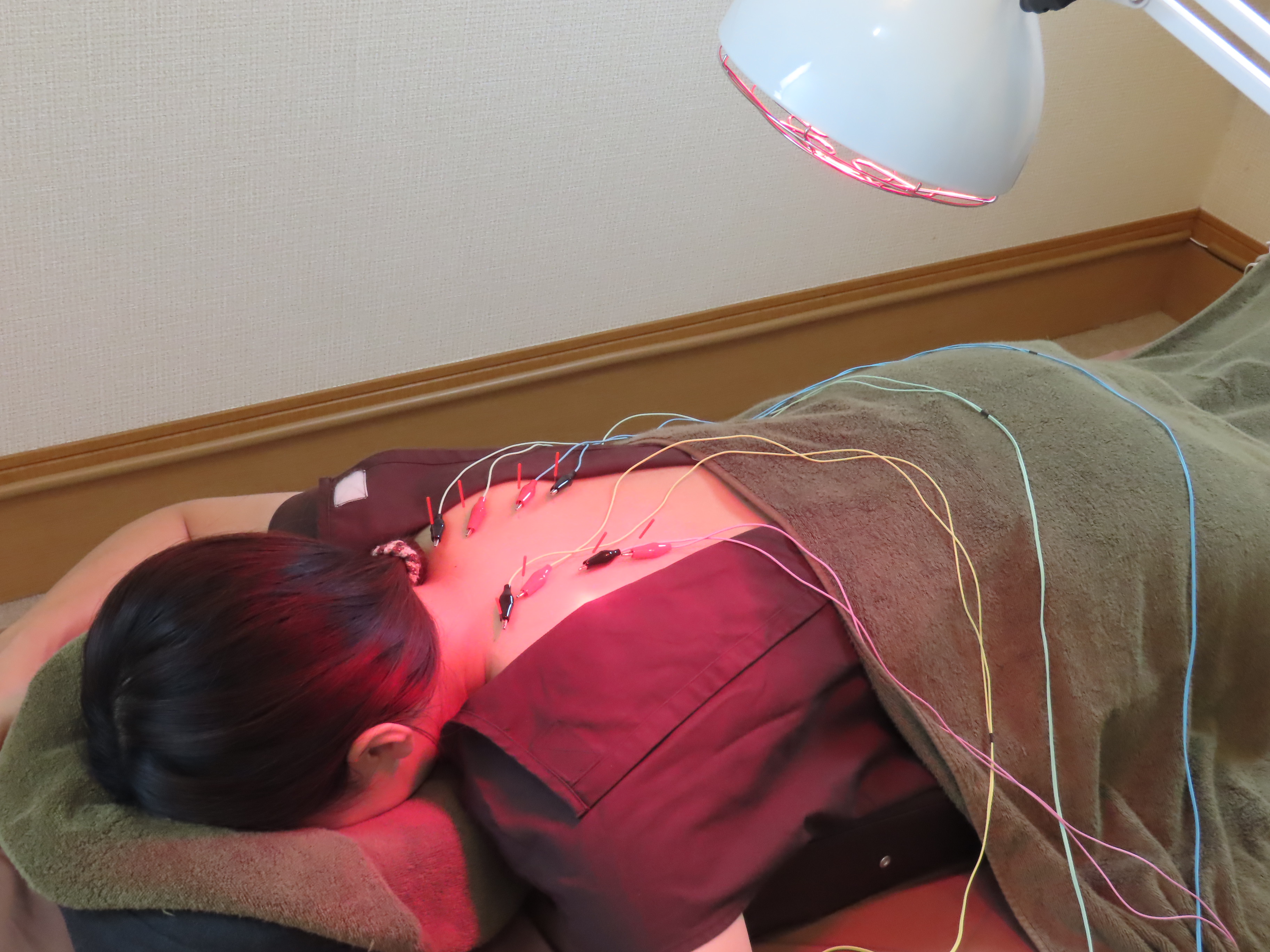 5. 頭痛緩和のための鍼灸